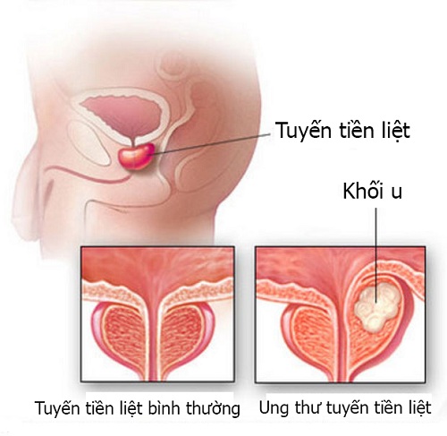 PSA và fPSA – Dấu ấn của  ung thư tuyến tiền liệt