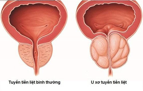 Viêm đường tiết niệu – Biến chứng hay gặp của phì đại tiền liệt tuyến