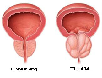 Phì đại tuyến tiền liệt ảnh hưởng đến chuyện vợ chồng