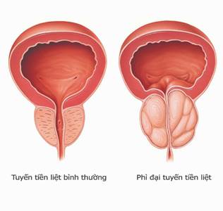 Phì đại tuyến tiền liệt uống thuốc gì?