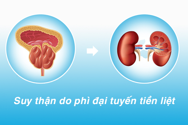 Mách bạn các biện pháp giúp phòng ngừa biến chứng suy thận do phì đại tuyến tiền liệt