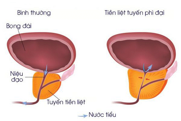 Cần khám những gì để biết mình bị phì đại tiền liệt tuyến? Khi nào cần mổ, khi nào không?