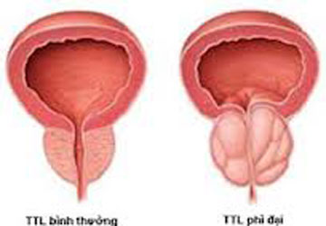 Phì đại tiền liệt tuyến – Nguyên nhân và giải pháp